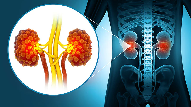 Major Changes Highlighted in New CKD Management Guidelines