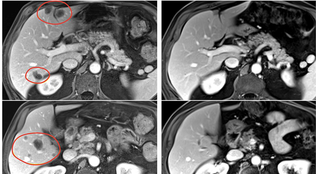 Combination immunotherapy shrank a variety of metastatic gastrointestinal cancers