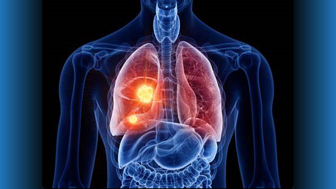 Nivolumab Plus Chemotherapy Before Surgery Improves Survival in Lung Cancer