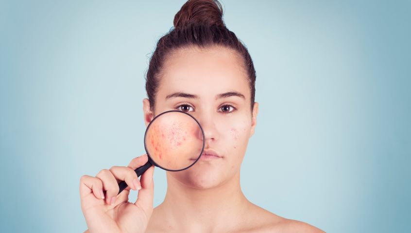 Is that Acne or Rosacea on Your Skin?