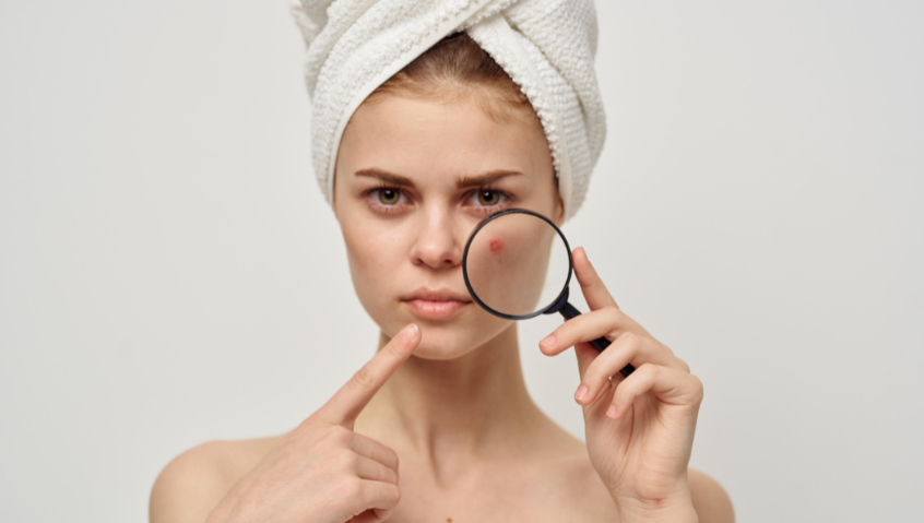 Analysis Reveals Recent Acne Prescribing Trends