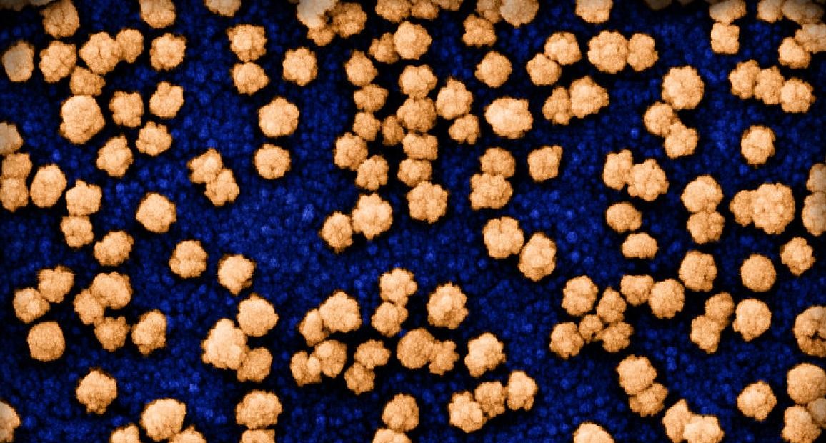 First wave of COVID-19 increased risk of heart attack, stroke up to three years later