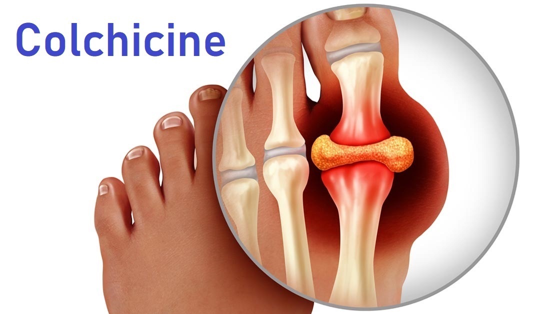 Colchicine Guards Heart While Fighting Gout Flares
