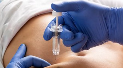 Subcutaneous Guselkumab Proves Efficacious for IBD in Two Studies: ASTRO and GRAVITI