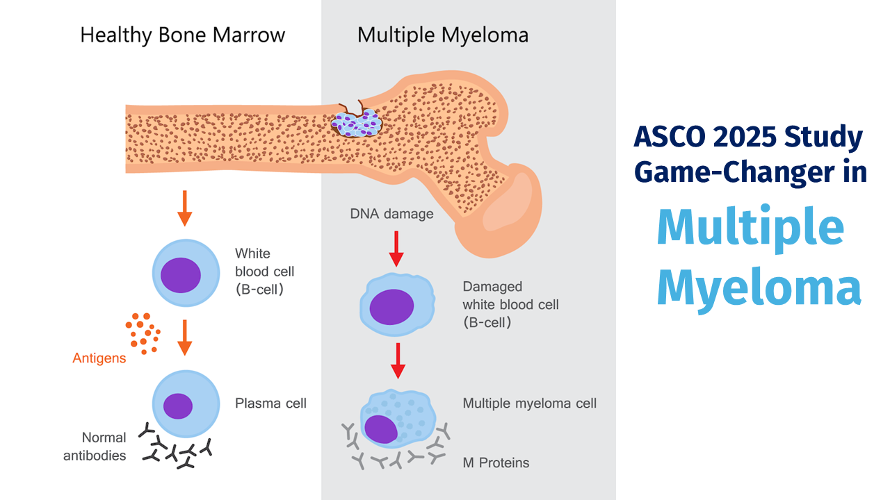 New 4-Drug Combination Offers New Hope for People with Newly Diagnosed Multiple Myeloma