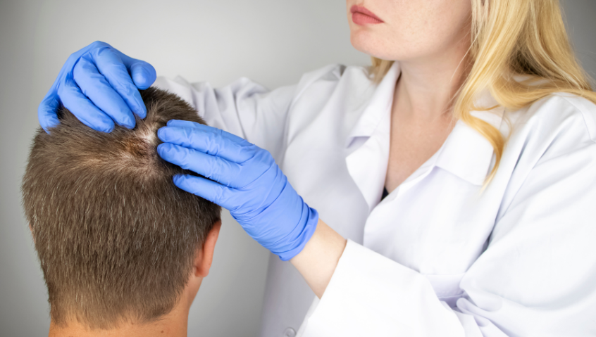 New treatments provide more options for people with alopecia areata