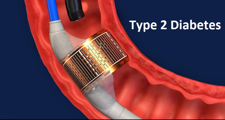 Type 2 Diabetes: Insulin-Free for 24 Months After Novel Endoscopic Procedure