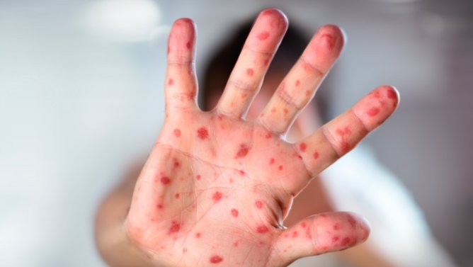 Bé gái phổi đông đặc do mắc cúm A và sởi: vì sao bệnh sởi ở trẻ có diễn biến nhanh và nặng?