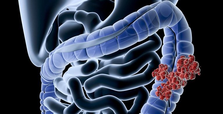 Bước Đột Phá Mới Trong Điều Trị Ung Thư Ruột Kết Giai Đoạn 3: Kết Hợp Miễn Dịch và Hóa Trị Giảm Một Nửa Nguy Cơ Tái Phát và Tử Vong