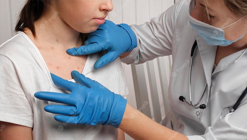 Ca mắc thuỷ đậu ở Hà Nội tăng cao, tuân thủ 5 khuyến cáo của Bộ Y tế để phòng tránh